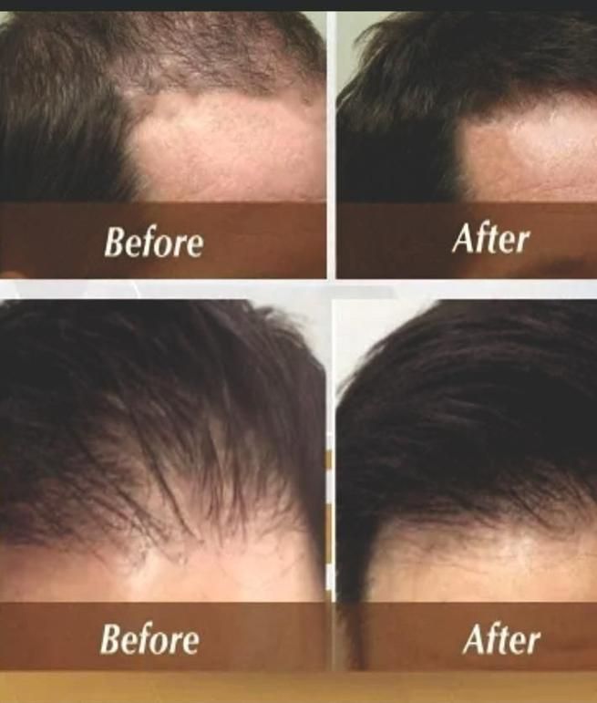 FGE Plus Hair Growth Spray 50 ml each Pack of 2